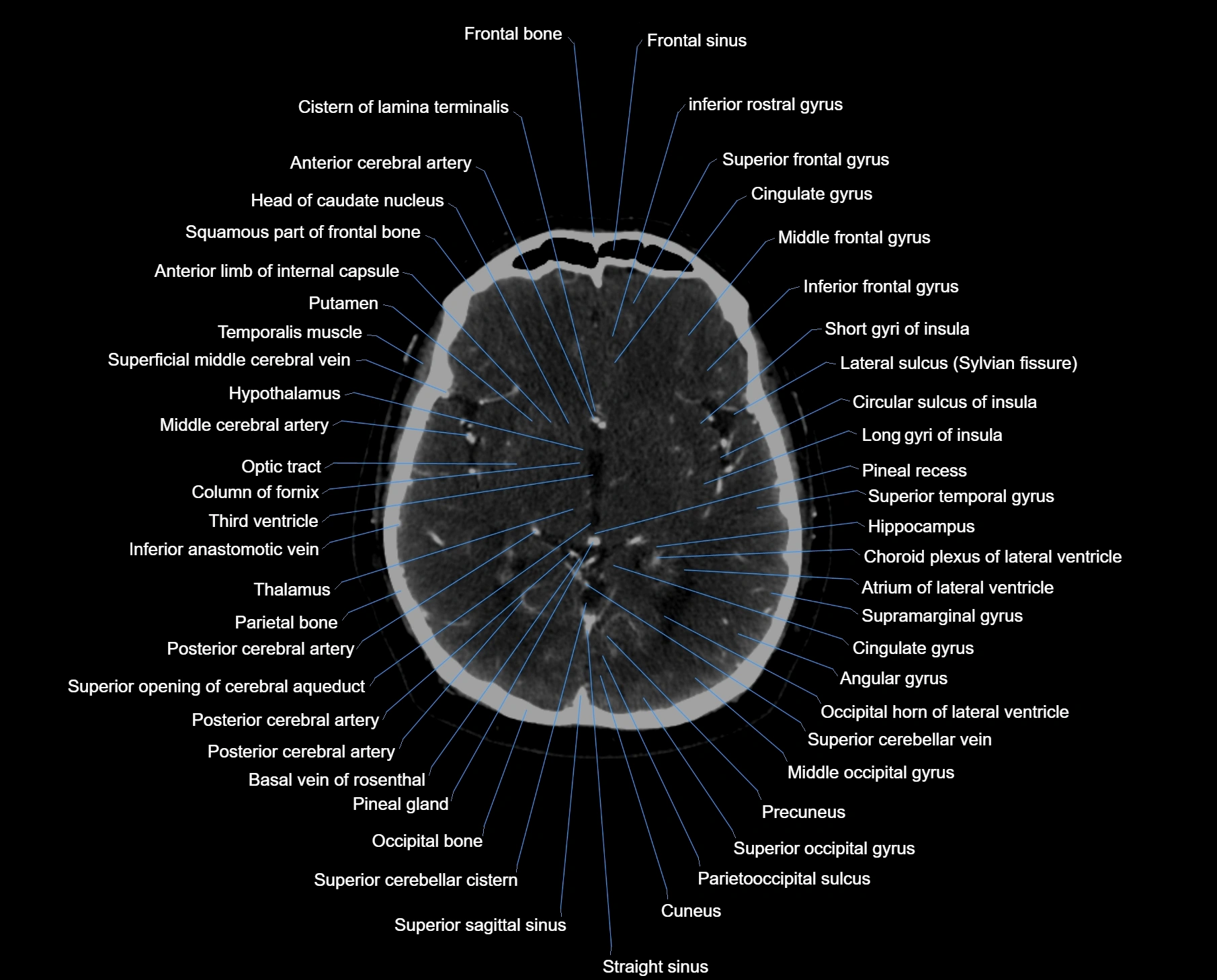 CT scan brain axial labelled cross sectional anatomy image-img-000033.webp